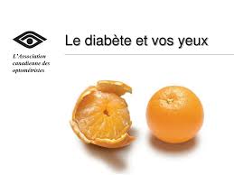 Check spelling or type a new query. Ppt Le Diabete Et Vos Yeux Powerpoint Presentation Free Download Id 3096624