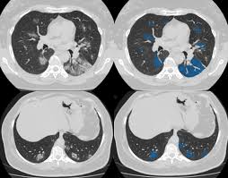 Afbeelding van de organen in de thoraxholte met een grotere. Ct Scan Database Of 1000 Sets Was Created For Teaching Ai To Diagnose Covid 19