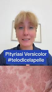 Pitiriasis Versicolor