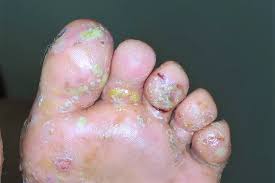 Image result for dyshidrosis