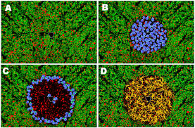 Relapses In Multiple Sclerosis Relationship To Disability Multiple Sclerosis And Related Disorders