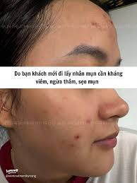 Hành trình 1 tháng phục hồi da sau mụn 🍋✨