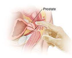 — written by zia ali on october 7, 2019. Prostate Cancer Screening Saint Luke S Health System