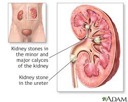 Image result for Nephrolithiasis