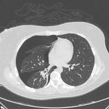 Thoracic endometriosis is defined as the presence of endometrial tissue in or around the thoracic a ct scan or mri are also highly useful imaging tests that an endometriosis specialist may advise. Catamenial Pneumothorax Radiology Reference Article Radiopaedia Org