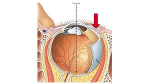 Maybe you would like to learn more about one of these? When The Neural Part Of The Retina Separates From The Chegg Com