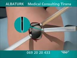 Jumătate din sumă o reprezintă fondurile nerambursabile. 1 Proteza Koksofemoral Wmv Youtube