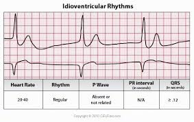 Ceufast Com Idioventricular Rhythms Ecg Interpretation Paramedic School Cardiac Nursing