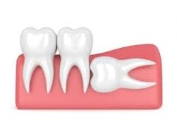 Here are some healthy natural ingredients which you can use to remove your teeth stains effectively. 5 Reasons Why You May Need A Tooth Extraction Gentle Care Dentistry