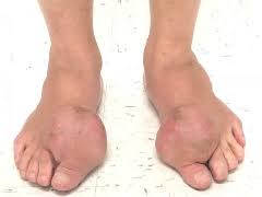 Image result for gout symptoms toe