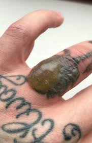 Who says men can't get delicate tattoos. Tattoo Removal Gone Wrong Treatment Leaves Man With Swollen Blister News Com Au Australia S Leading News Site