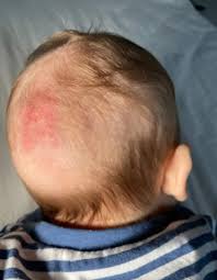 Does your baby have dry scalp? 3 Reasons For Your Toddler S Dry Scalp Best Treatment Options Healthweakness