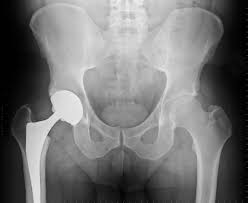 Image result for Hip XRay
