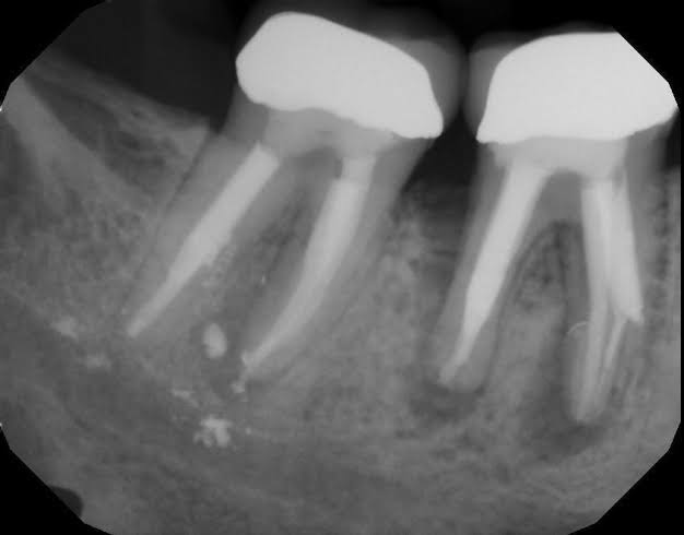 Re-RCT product image
