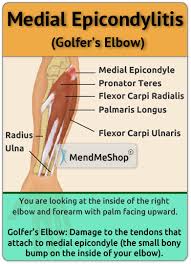 Medial epicondyle of the femur right knee joint. Information About Medial Epicondylitis Aka Golfers Elbow