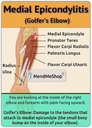 Not surprisingly, playing tennis or other racquet sports can cause this condition. Information About Medial Epicondylitis Aka Golfers Elbow