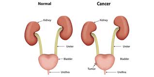Urinary Bladder Cancer Treatment Hospital In India Rg Hospital