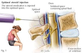 Epidural Steroid Injection