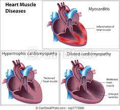 Many people who get myocarditis are otherwise. Diseases Of Heart Muscle Eps8 Canstock