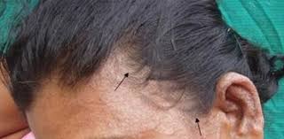 Hair loss can be associated with a whole raft of different medical complaints, but candida is not usually one of them that's going to be associated with hair loss. Do Fungal Infections Cause Hair Loss Hairguard