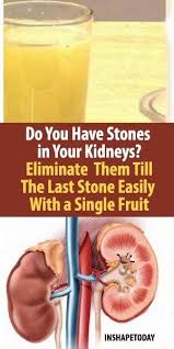 Do You Have Stones In Your Kidneys Eliminate Them Till The Last Stone Easily With A Single Fruit In Kidney Stones Remedy Kidney Stones Passing Kidney Stones