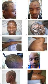 Photographic Appearance and Evolution of Molluscum Contagiosum in... |  Download Scientific Diagram