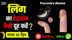 लिंग का टेढ़ापन कैसे दूर करे | Ling Ka Tedapan Dur Kese Kre | Ling Ko Sidha  Karne Ka Upay
