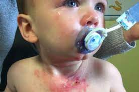 Kulit yang terkena air panas memang sering kali membuat kita panik karena termasuk dalam kategori luka bakar. Anak Kena Air Panas Luka Bakar Pada Bayi Ketumpahan Air Panas Theasianparent Indonesia