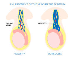 Image result for Varicocele