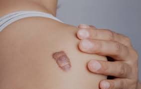 Keloid Scar Removal London The Dermatology Clinic London