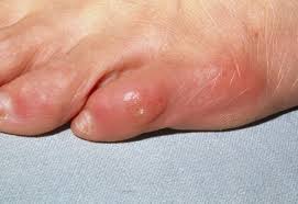 Even weight distribution can prevent calluses. Calluses And Corns Dermatologic Disorders Msd Manual Professional Edition