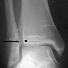 There will be reduced strength but may be increased range of movement as the ligament is no longer. Management Of Ankle Sprains American Family Physician