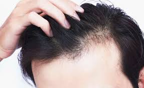 Maintaining a male afro requires daily attention and special hair care. Hairfall In Men V Plant Advanced Hair Care Clinics Male Pattern Baldness