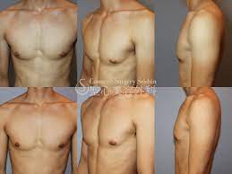 20代男性・膨らみの改善】軽度の女性化乳房（3ヶ月後） - 症例写真 - 美容整形、美容外科なら聖心美容クリニック