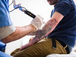 Fortier also has extensive experience in medical laser technology for tattoo removal, skin revitalization, acne treatment and hair removal treatment. Laser Technology Is Making Tattoo Removal Easier Than Ever Innovation Smithsonian Magazine