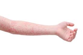 Image result for Scarlet Fever