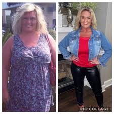 The best plastic surgeons in tijuana will have a certification from the plastic surgery board of mexico. Post Bariatric Plastic Cosmetic Surgery Options In Mexico