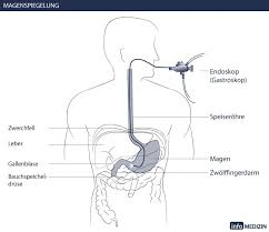 Magenspiegelung Gastroskopie Infos Ablauf Kosten Info Medizin