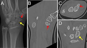 Image result for Scaphoid Fracture