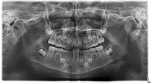 Panoramic X-ray Montclair, NJ | Ferguson Dental Associates