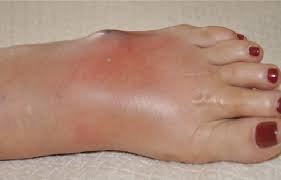 Most bites result in mild symptoms around the area of the bite. Diagnosing And Treating Insect Bites And Stings On The Lower Extremity Podiatry Today