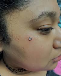 Single point piercing (Microdermal) done