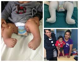 Check spelling or type a new query. A Clubfoot Journey In Ecuador Miraclefeet