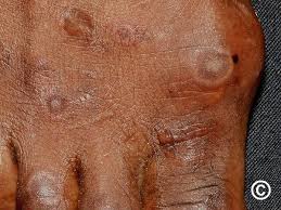 Image result for Erythema Multiforme Major