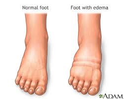 What are the symptoms of foot melanoma? Foot Leg And Ankle Swelling Information Mount Sinai New York