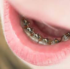 Schiefe Zahne Lohnt Sich Die Zahnspange Fur Erwachsene Welt