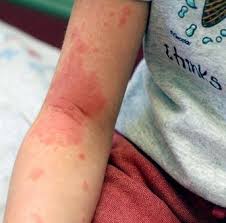 Even though your rash can go away on its own in 1 to 3 weeks, your skin will feel better if you take some steps if the rash becomes infected, you may need to take an oral antibiotic. Best Remedies For Treating Poison Ivy At Home Poison Ivy Remedies Natural Home Remedies Home Remedies