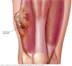 A tendon is the fibrous tissue that attaches muscle to bone in the human body. Soft Tissue Sarcoma Symptoms And Causes Mayo Clinic
