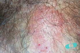 Guia De La Piel Psoriasis Genital