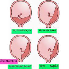 علامات نزول المشيمة المشيمة المنزاحة و اعراضها قبلات الحياة